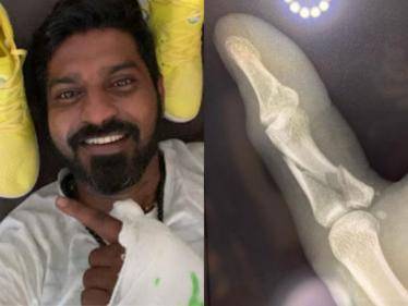 vj ma ka pa anand finger injury and fractured xray photo goes viral on social media